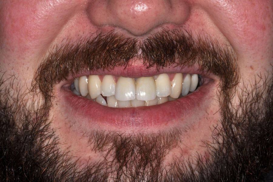What Material Are Dental Implants Made Of - single tooth implant - after - 3Dental